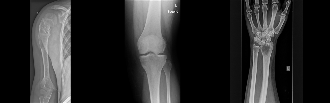 Tirol Kliniken Ortho Trauma Innsbruck Gutartige Knochentumore